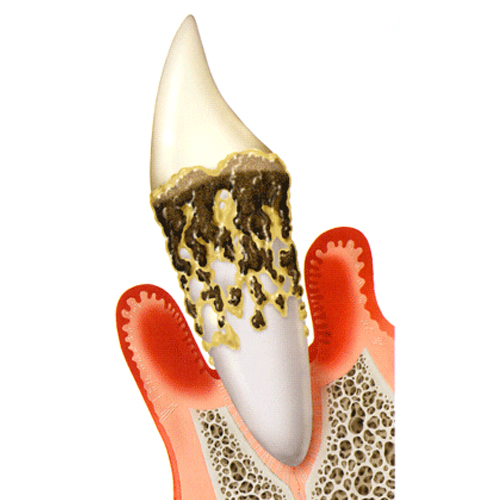 歯周病治療