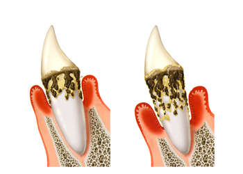 歯周病とは？