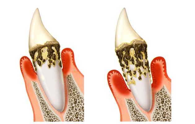 歯周病
